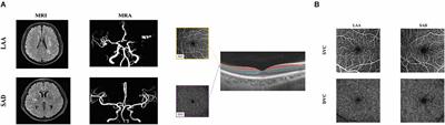 Differences in retinal microvasculature between large artery atherosclerosis and small artery disease: an optical coherence tomography angiography study